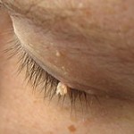 200px-Wart_filiform_eyelid